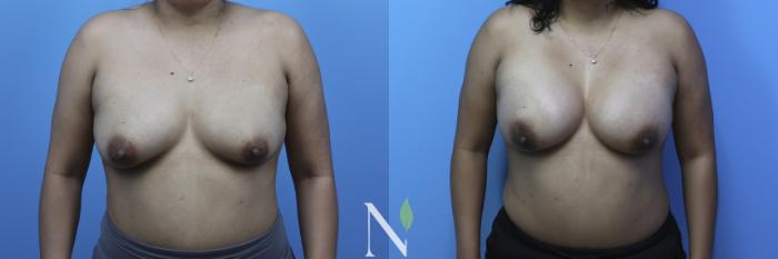 Before & After Breast Augmentation Case 179 Front View in Raleigh, NC