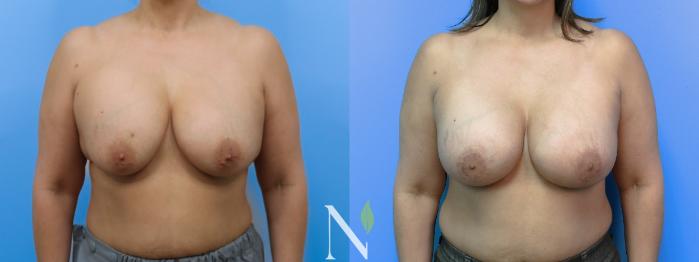 Before & After Breast Augmentation Case 184 Front View in Raleigh, NC