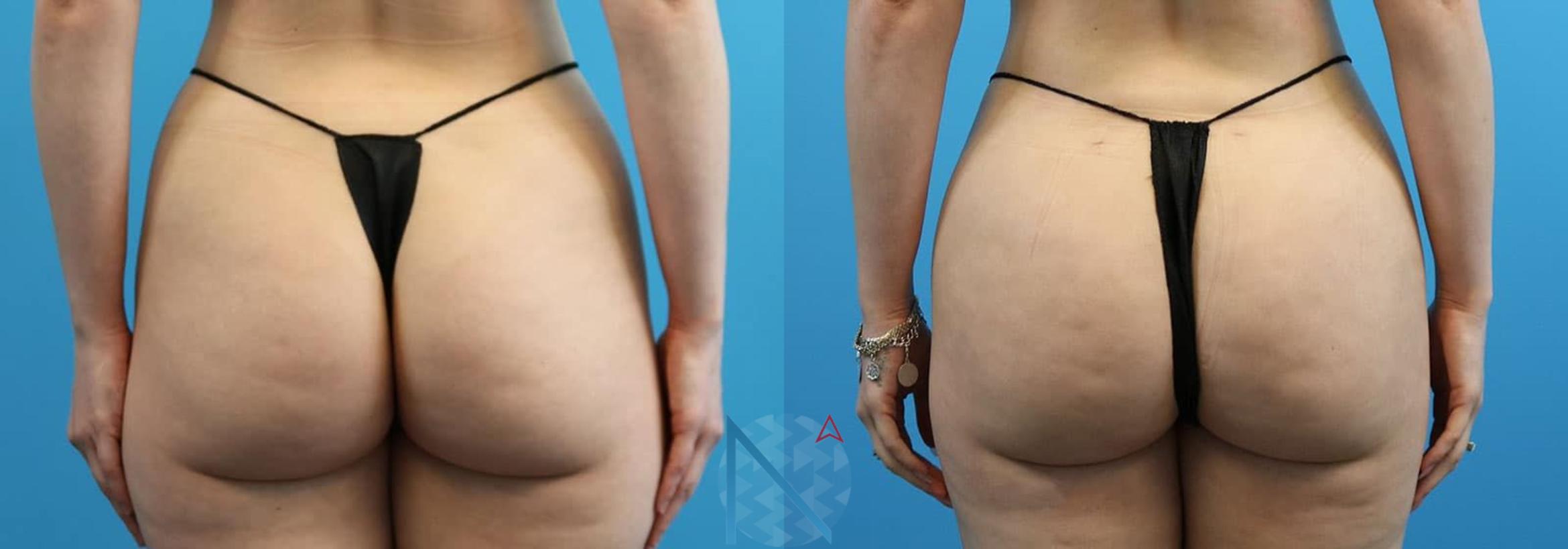 Before & After Brazilian Butt Lift Case 83 View 1 View in Raleigh, NC