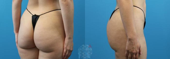 Before & After Brazilian Butt Lift Case 83 View 2 View in Raleigh, NC