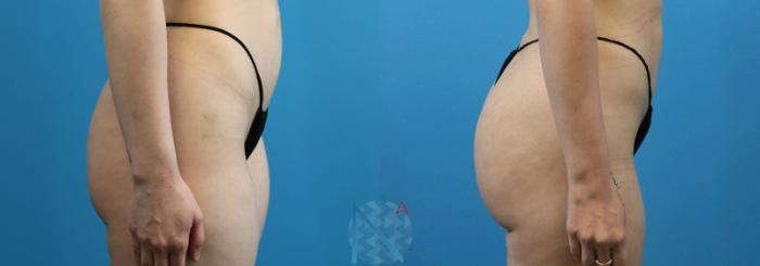 Before & After Brazilian Butt Lift Case 83 View 3 View in Raleigh, NC