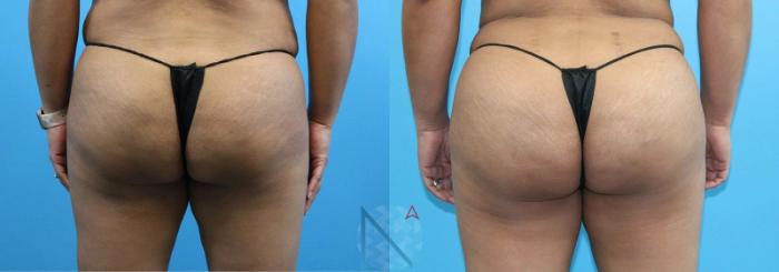 Before & After Brazilian Butt Lift Case 84 View 1 View in Raleigh, NC