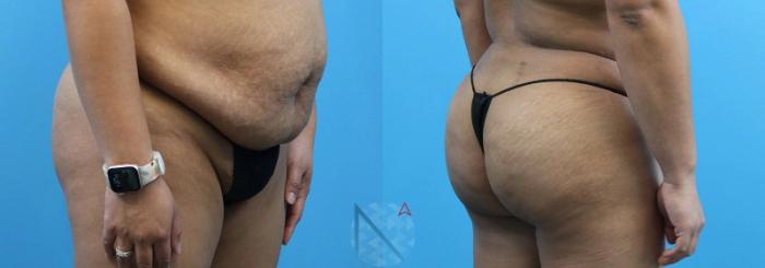 Before & After Brazilian Butt Lift Case 84 View 2 View in Raleigh, NC