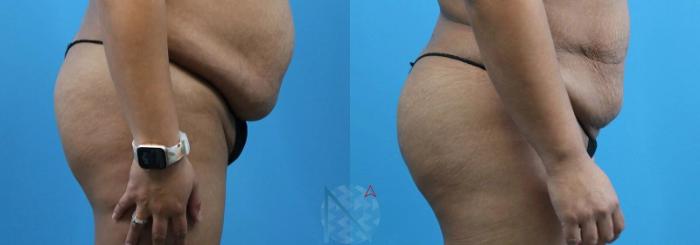 Before & After Brazilian Butt Lift Case 84 View 3 View in Raleigh, NC