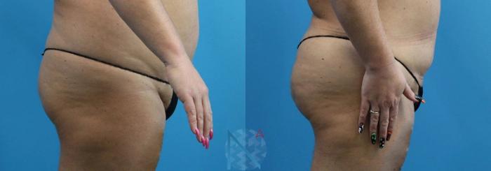 Before & After Brazilian Butt Lift Case 85 View 2 View in Raleigh, NC