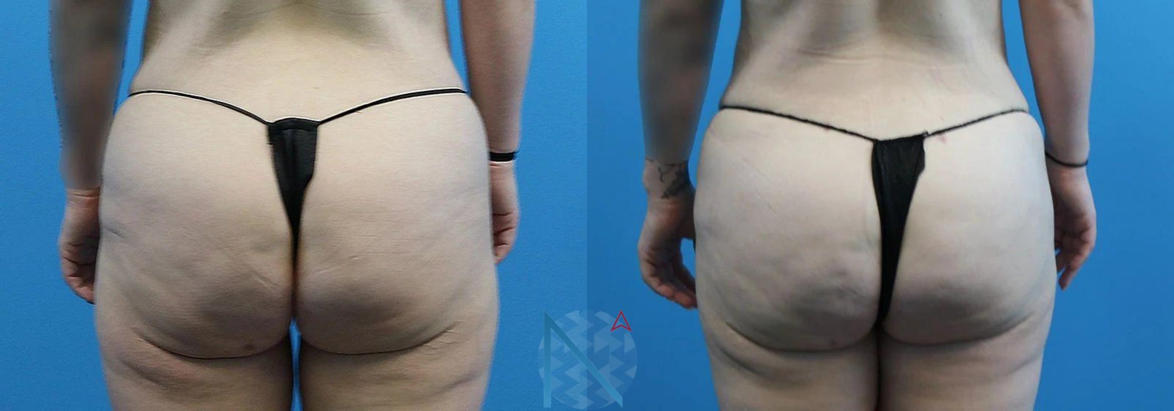 Before & After Brazilian Butt Lift Case 86 View 1 View in Raleigh, NC