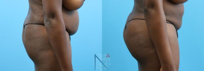 Before & After Brazilian Butt Lift Case 87 View 3 View in Raleigh, NC