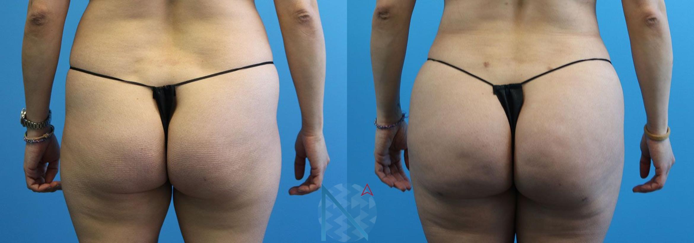 Before & After Brazilian Butt Lift Case 88 View 1 View in Raleigh, NC