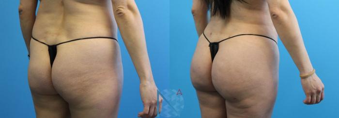 Before & After Brazilian Butt Lift Case 88 View 2 View in Raleigh, NC