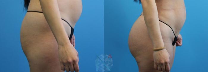 Before & After Brazilian Butt Lift Case 88 View 3 View in Raleigh, NC