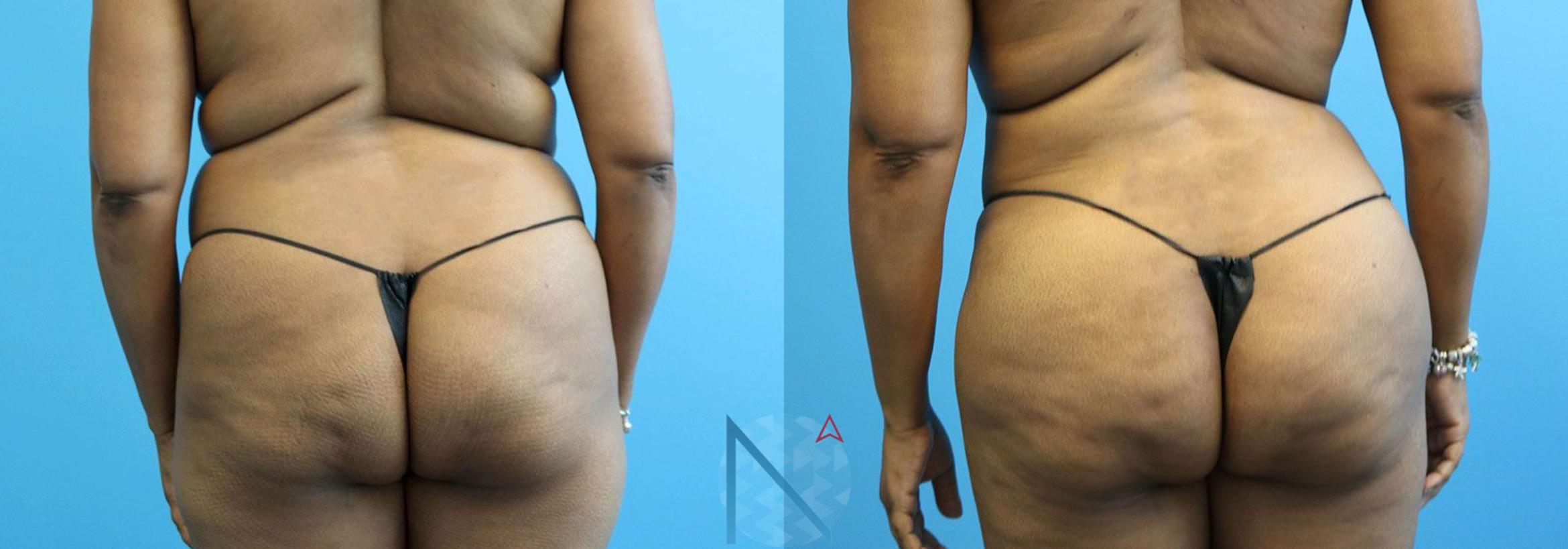 Before & After Brazilian Butt Lift Case 89 View 1 View in Raleigh, NC