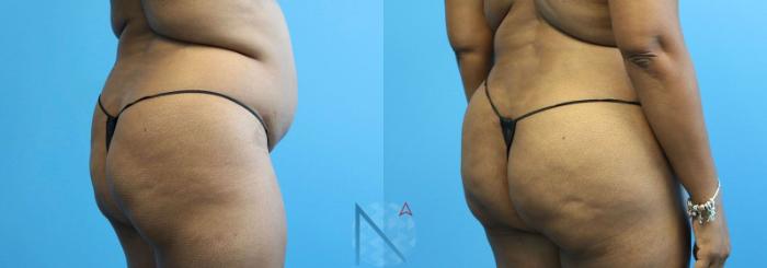 Before & After Brazilian Butt Lift Case 89 View 2 View in Raleigh, NC