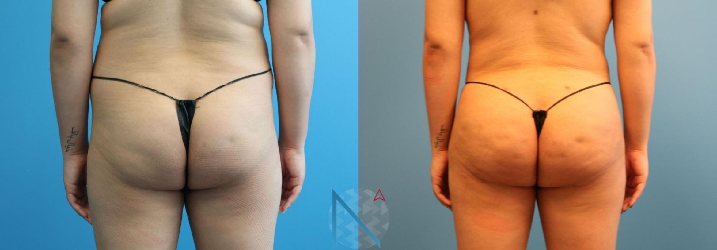 Before & After Brazilian Butt Lift Case 90 View 1 View in Raleigh, NC