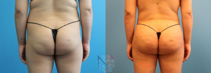 Before & After Brazilian Butt Lift Case 90 View 1 View in Raleigh, NC