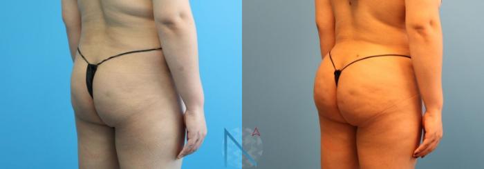 Before & After Brazilian Butt Lift Case 90 View 2 View in Raleigh, NC