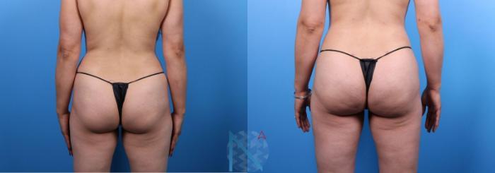 Before & After Brazilian Butt Lift Case 92 View 1 View in Raleigh, NC