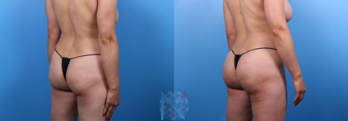 Before & After Brazilian Butt Lift Case 92 View 2 View in Raleigh, NC