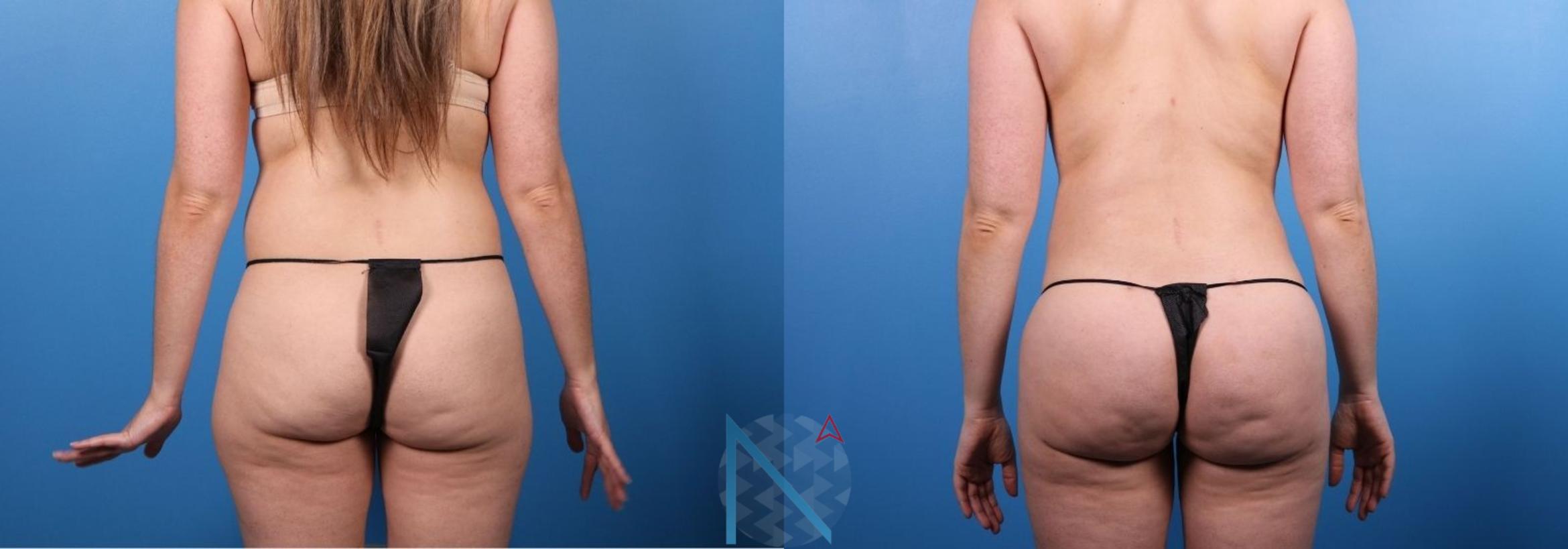 Before & After Brazilian Butt Lift Case 93 View 1 View in Raleigh, NC