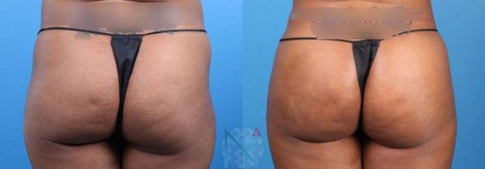 Before & After Brazilian Butt Lift Case 94 View 1 View in Raleigh, NC