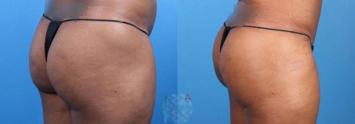 Before & After Brazilian Butt Lift Case 94 View 2 View in Raleigh, NC