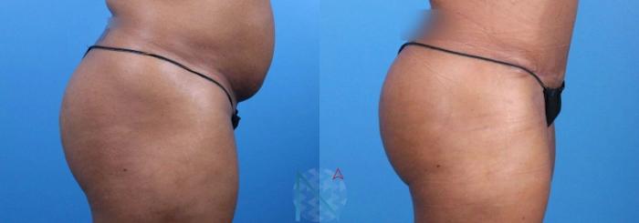 Before & After Brazilian Butt Lift Case 94 View 3 View in Raleigh, NC