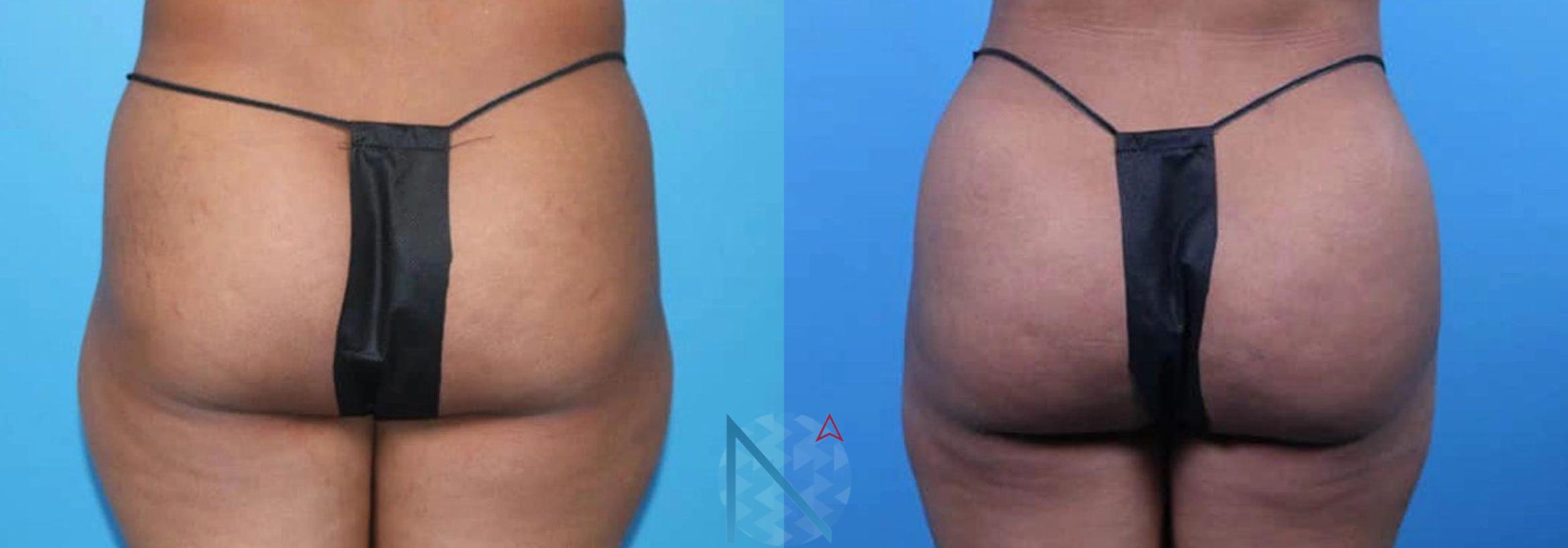 Before & After Brazilian Butt Lift Case 95 View 1 View in Raleigh, NC