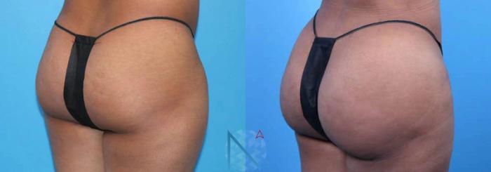 Before & After Brazilian Butt Lift Case 95 View 2 View in Raleigh, NC