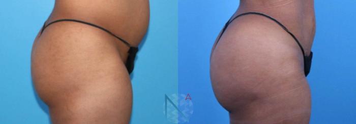 Before & After Brazilian Butt Lift Case 95 View 3 View in Raleigh, NC