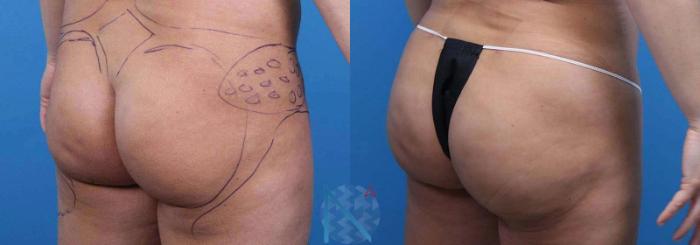 Before & After Brazilian Butt Lift Case 96 View 2 View in Raleigh, NC