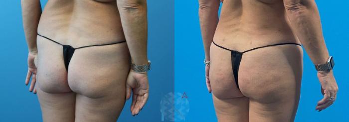 Before & After Brazilian Butt Lift Case 98 View 2 View in Raleigh, NC