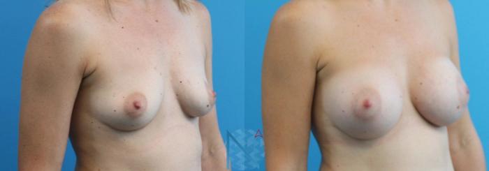 Before & After Breast Augmentation Case 16 View 2 View in Raleigh, NC