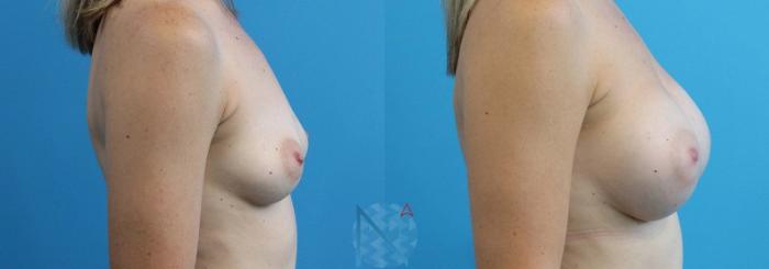 Before & After Breast Augmentation Case 16 View 3 View in Raleigh, NC