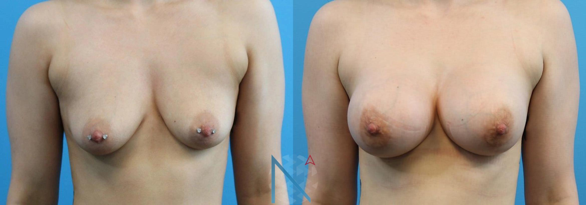 Before & After Breast Augmentation Case 17 View 1 View in Raleigh, NC