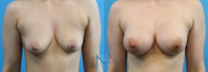 Before & After Breast Augmentation Case 17 View 1 View in Raleigh, NC