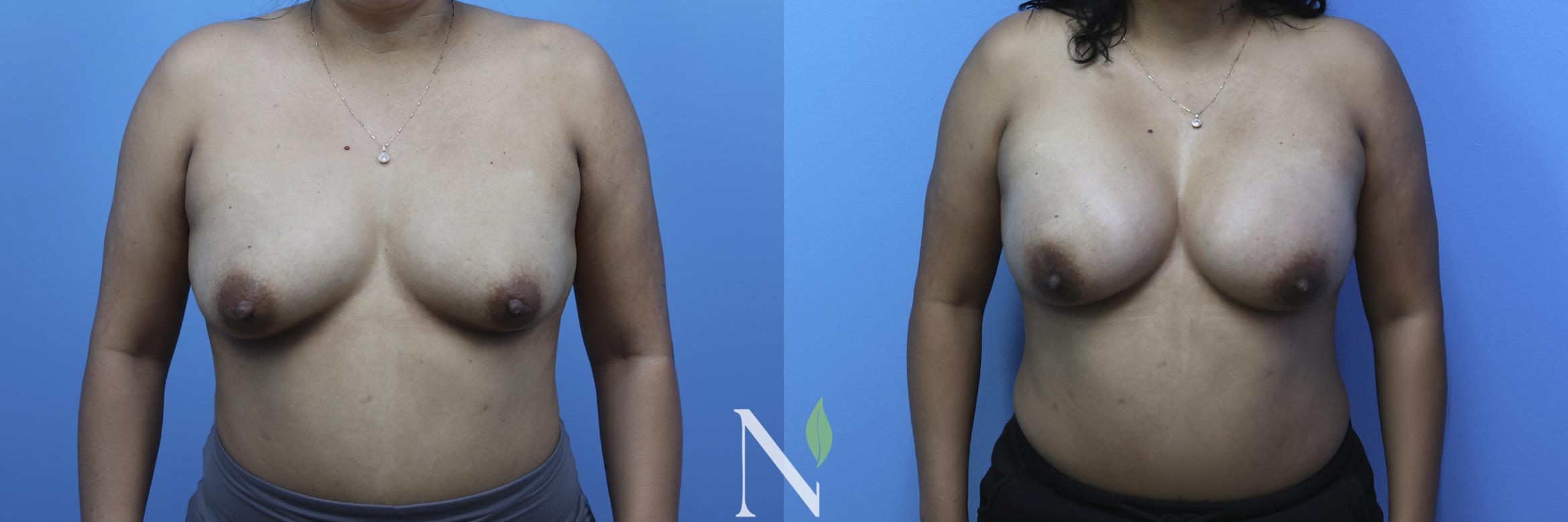 Before & After Breast Augmentation Case 179 Front View in Raleigh, NC