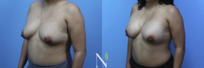 Before & After Breast Augmentation Case 179 Left Oblique View in Raleigh, NC