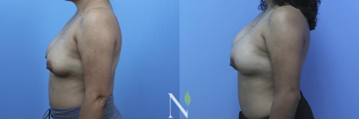 Before & After Breast Augmentation Case 179 Left Side View in Raleigh, NC