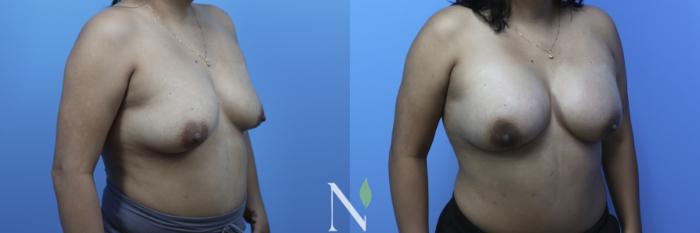 Before & After Breast Augmentation Case 179 Right Oblique View in Raleigh, NC