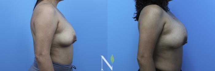 Before & After Breast Augmentation Case 179 Right Side View in Raleigh, NC