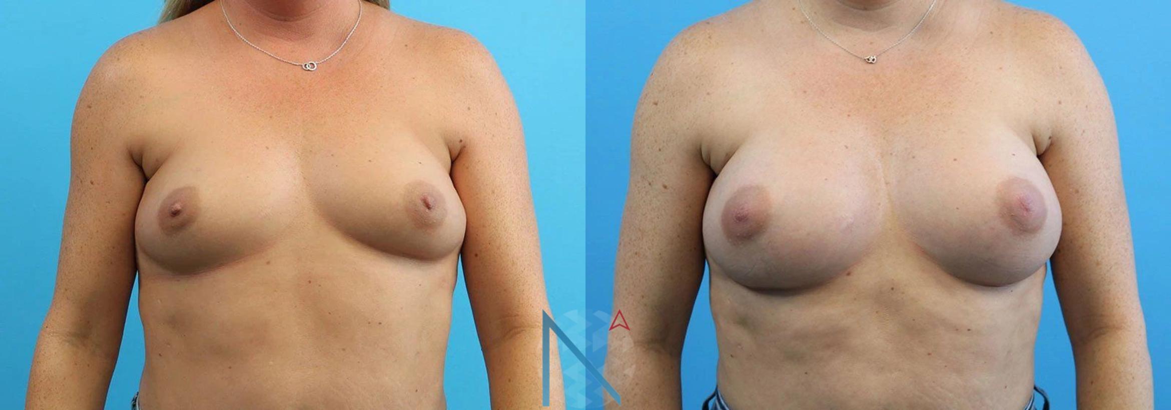 Before & After Breast Augmentation Case 18 View 1 View in Raleigh, NC