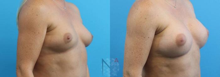 Before & After Breast Augmentation Case 18 View 2 View in Raleigh, NC