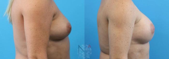 Before & After Breast Augmentation Case 18 View 3 View in Raleigh, NC