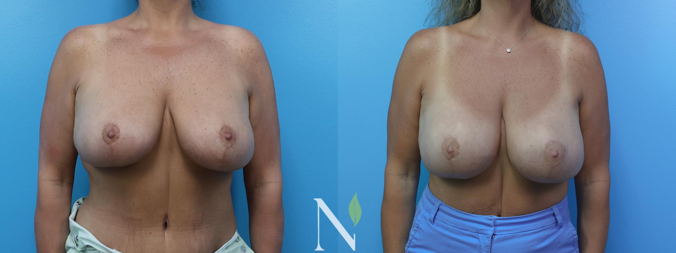 Before & After Breast Augmentation Case 181 Front View in Raleigh, NC