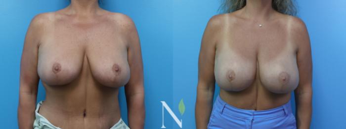 Before & After Breast Augmentation Case 181 Front View in Raleigh, NC