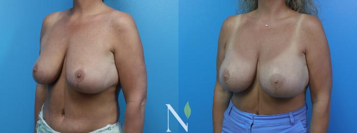 Before & After Breast Augmentation Case 181 Left Oblique View in Raleigh, NC