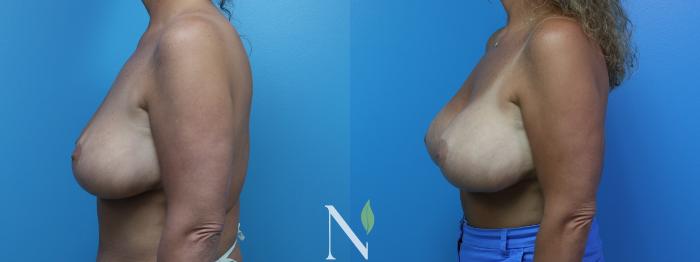 Before & After Breast Augmentation Case 181 Left Side View in Raleigh, NC