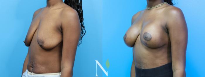 Before & After Breast Augmentation Case 182 Left Oblique View in Raleigh, NC