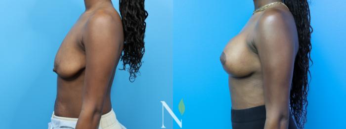 Before & After Breast Augmentation Case 182 Left Side View in Raleigh, NC
