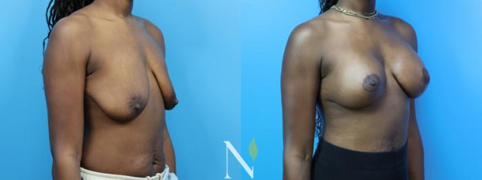 Before & After Breast Augmentation Case 182 Right Oblique View in Raleigh, NC