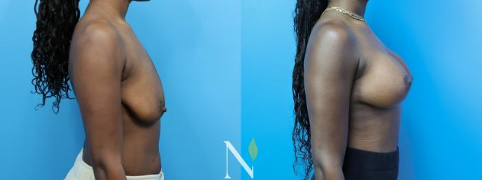 Before & After Breast Augmentation Case 182 Right Side View in Raleigh, NC